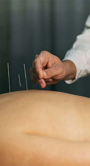 Acupuncture